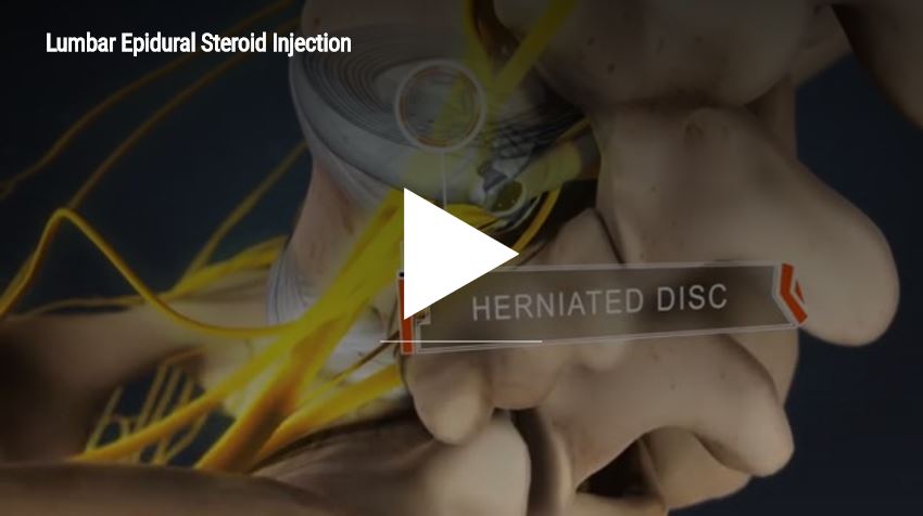 Lumbar Epidural Steroid Injection