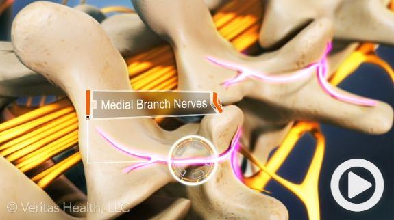 Medial Branch Nerve Block