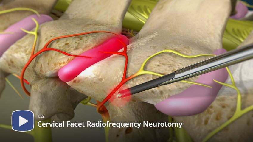 Radiofrequency Ablation of the Cervical Facets
